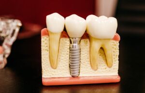 dental implant, Swasthya dental and wellness center