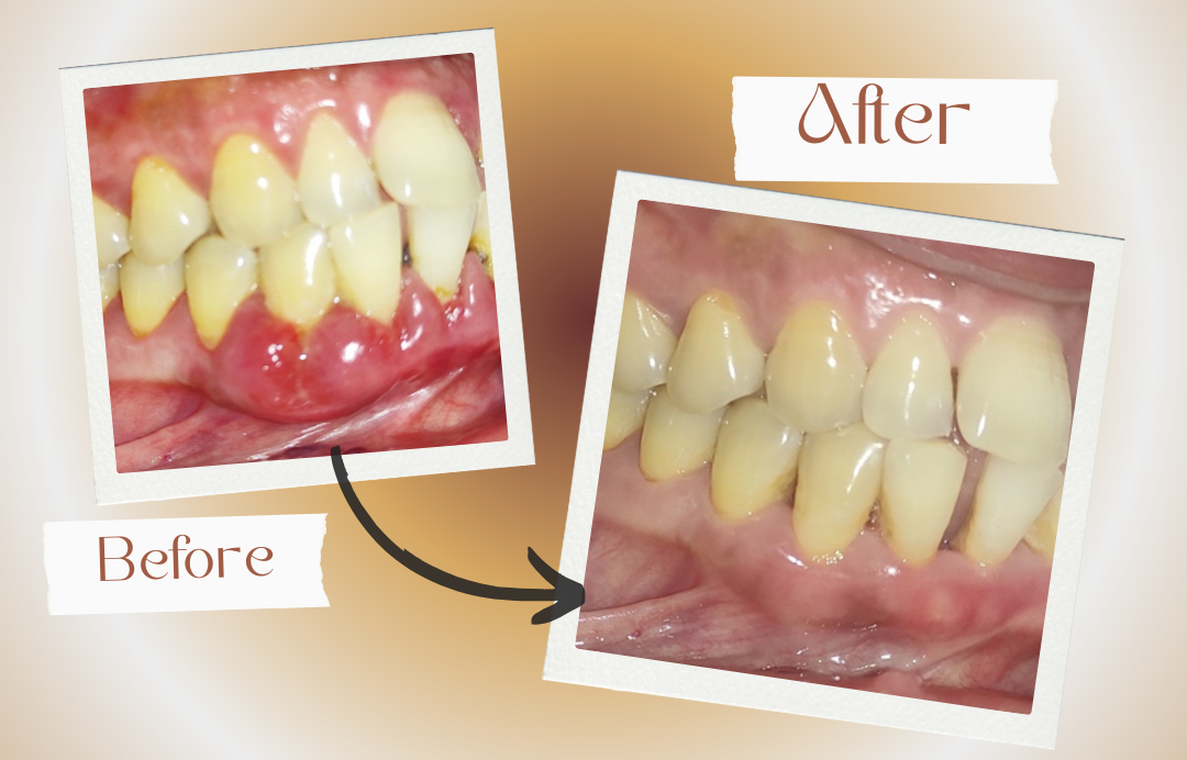scaling before and after swasthya dental and wellness center