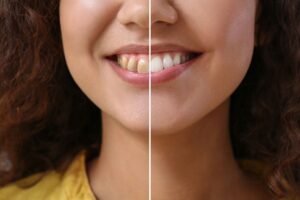 Smile Makeover, Swasthya dental and wellness center, teeth whitening